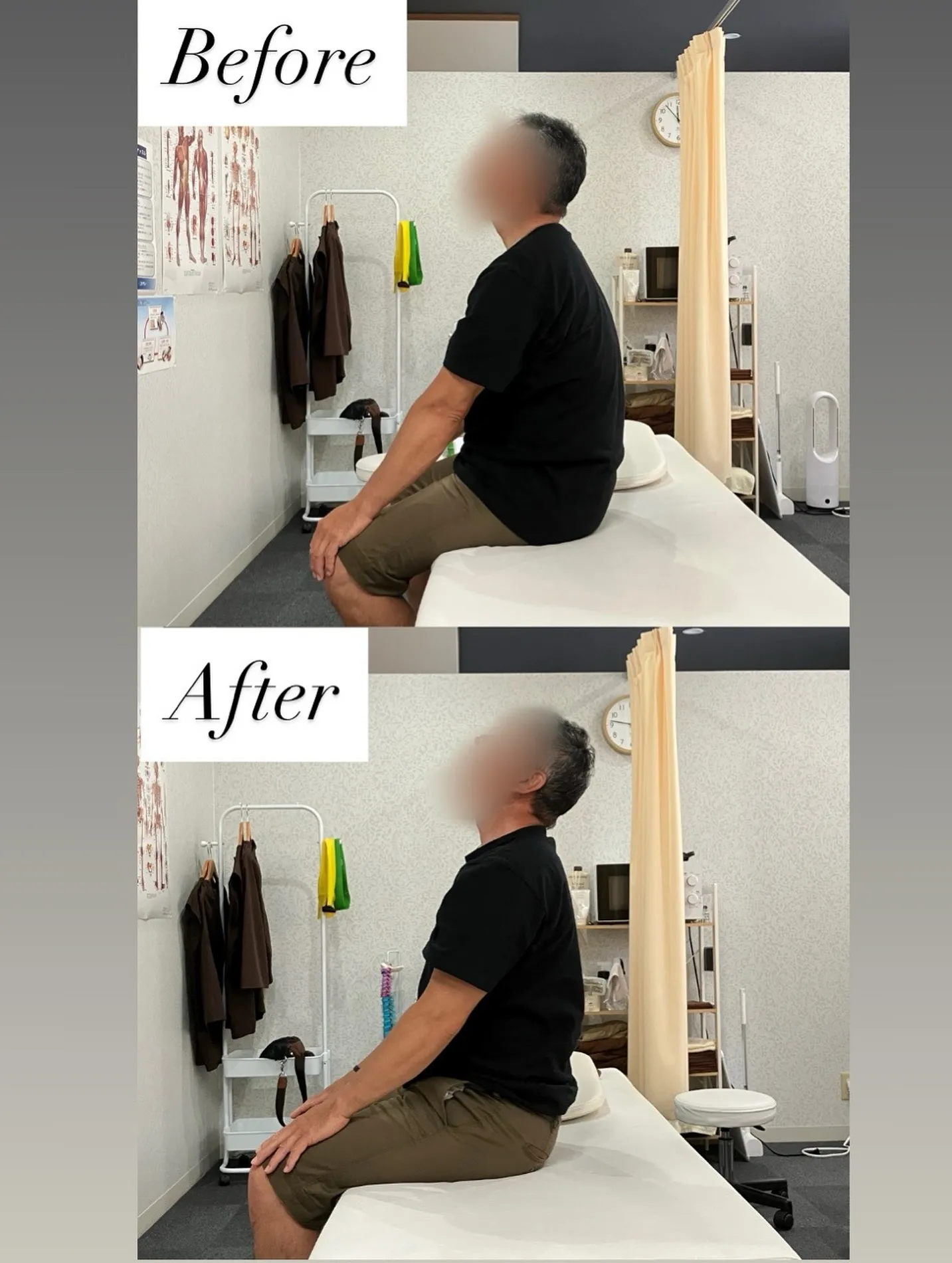 50代男性首からの神経痛Before→After❗️