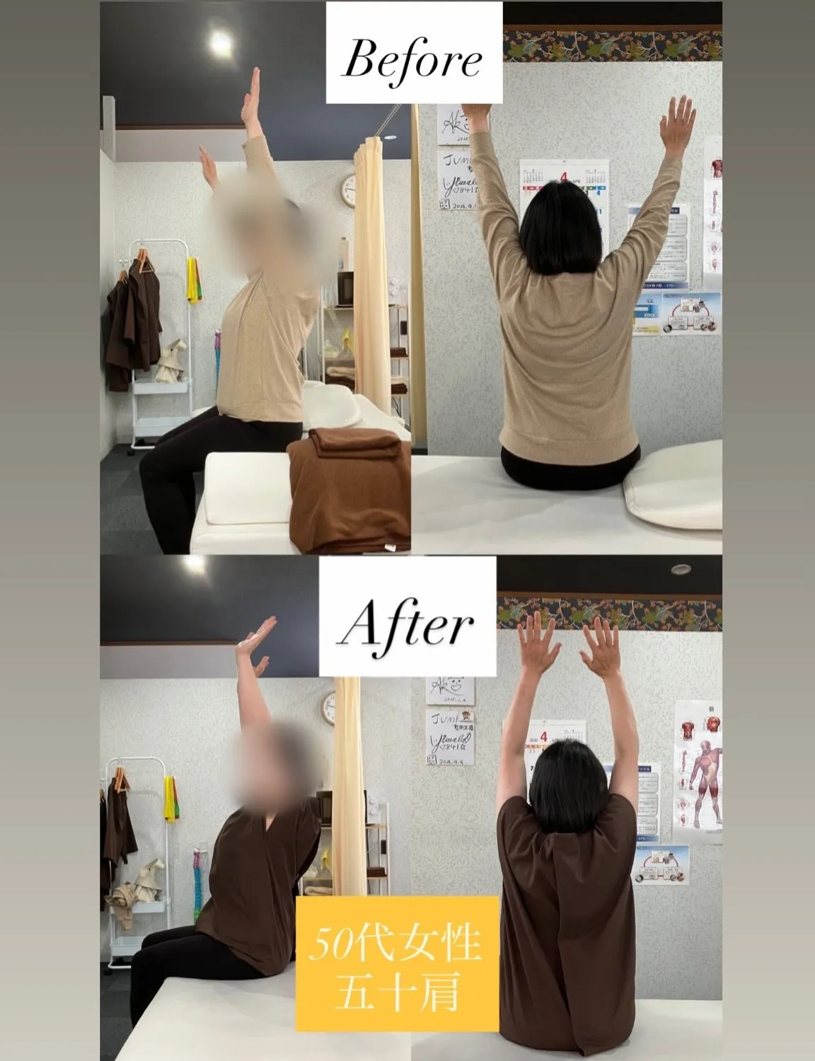 【50代女性/五十肩(右肩)】